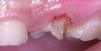 Cavity Preparation in Deciduous Teeth after