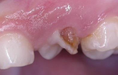 Cavity Preparation in Deciduous Teeth before