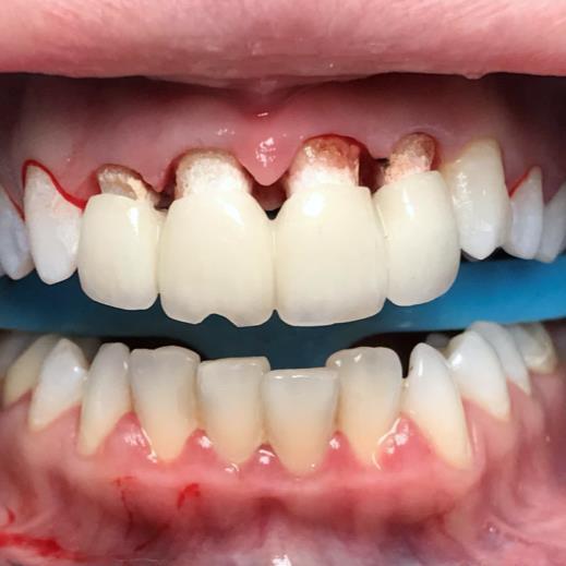 Ceramic Bridge Debonding after