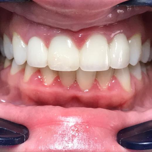 Ceramic Bridge Debonding before