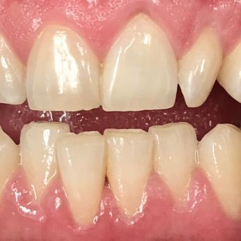 TouchWhite® Teeth Bleaching after