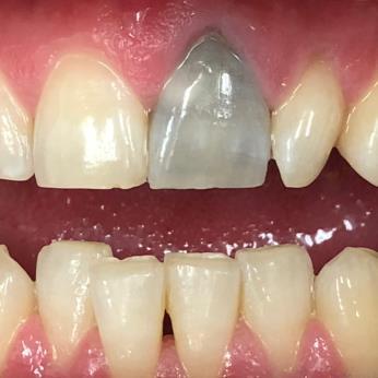 TouchWhite® Teeth Bleaching before
