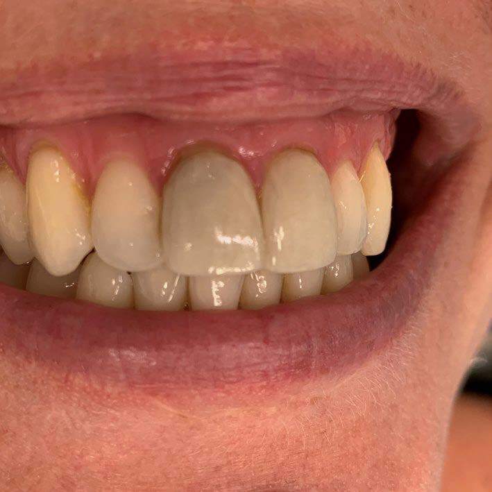 Veneer removal_rindeskog_before