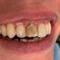 Veneer removal_rindeskog_during