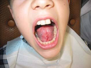 frenectomy after