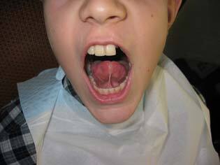 frenectomy before