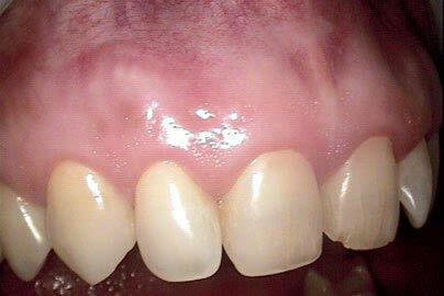 gingival melanin pigmentation_bisheimer_2023_after