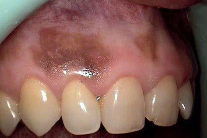 gingival melanin pigmentation_bisheimer_2023_before