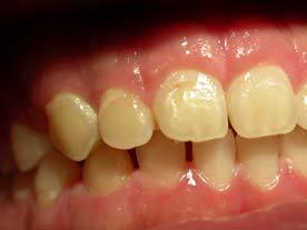 gingivectomy after