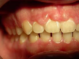 gingivectomy before
