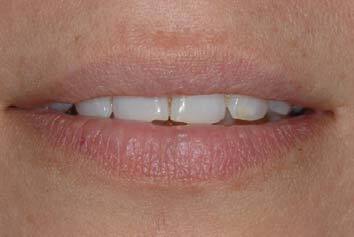 hemangioma after