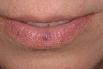 hemangioma before