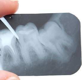 istock_000009713050_endodontic