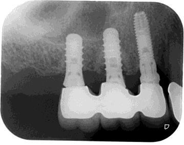 periimplantitis_after