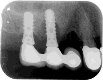 periimplantitis_before