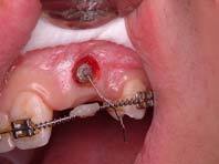 tooth exposure after-1