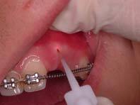 tooth exposure before