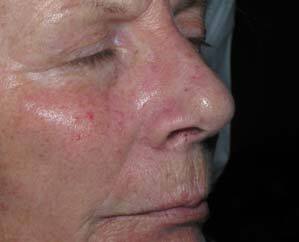 wrinkles after