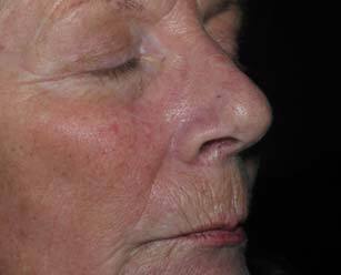 wrinkles before